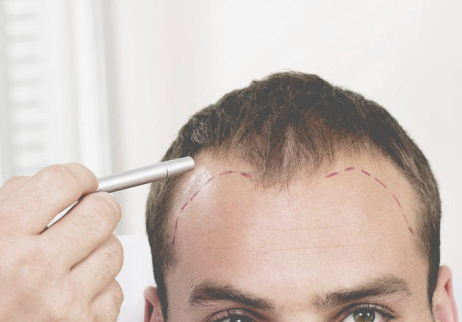 Success Rates of Hair Transplants: What the Data Says