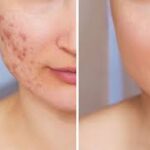 Scar Treatment in Noida