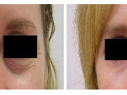 Evaluating the Success Rates of Eyelid Surgery Clinics