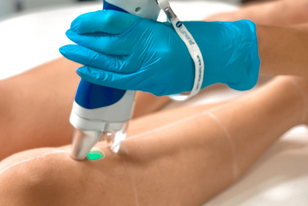 Hair Removal Bournemouth: Your Guide to Smooth, Hair-Free Sk