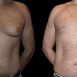 Male breast reduction with before and after results