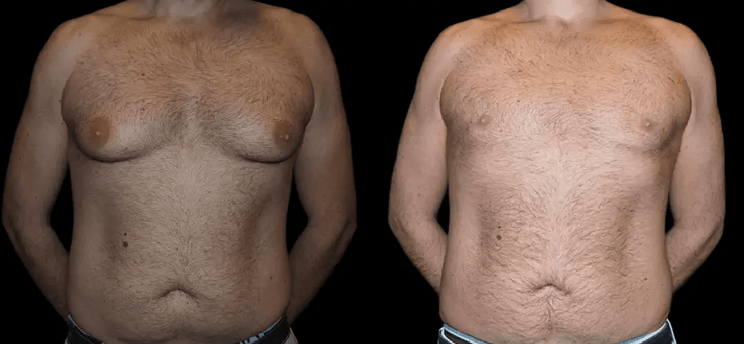 Male breast reduction with before and after results
