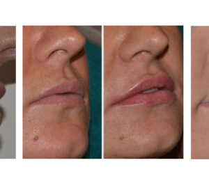 Where to Find Cheap Lip Injections Near Me?