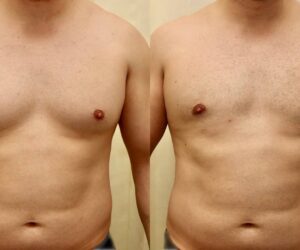 How to Find the Best Gynecomastia Surgeon in Dubai: Top Tips for Success
