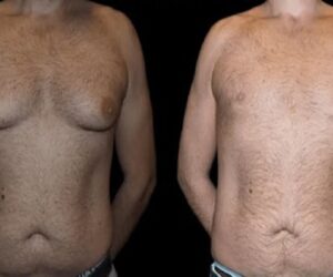 Educating Yourself About Gynecomastia: A Guide to Finding the Best Surgeons in Dubai