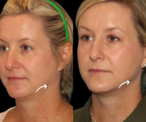 How to Prepare for Your Sculptra in Dubai Treatment
