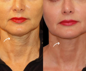 How Sculptra Injections in Dubai Work to Restore Facial Volume