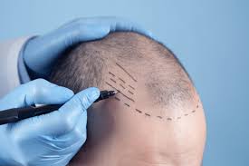 A Breakthrough in Hair Restoration: Detailed Hairline Crafting Scalp Treatment for Hair Loss