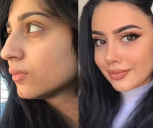 Top Qualities to Look for in the Best Rhinoplasty Surgeon in Dubai