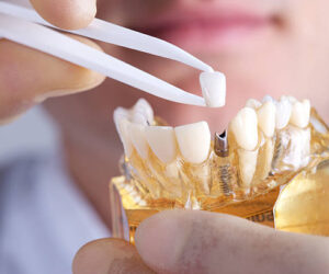 Karachi’s Best Invisible Aligners Dentist: Clear Path Aligners