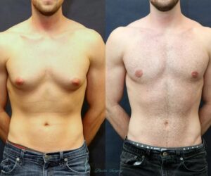 Gynecomastia in Dubai: Advanced Treatments for Lasting Results
