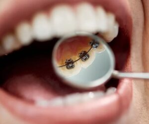 Do Braces Hurt? Debunking Myths and Managing Discomfort