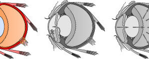 A Brief Overview of Glaucoma: Cause, Symptom and Gene Therapy Research
