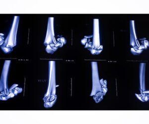When Should You Consider a CT Scan for a Bone Fracture?
