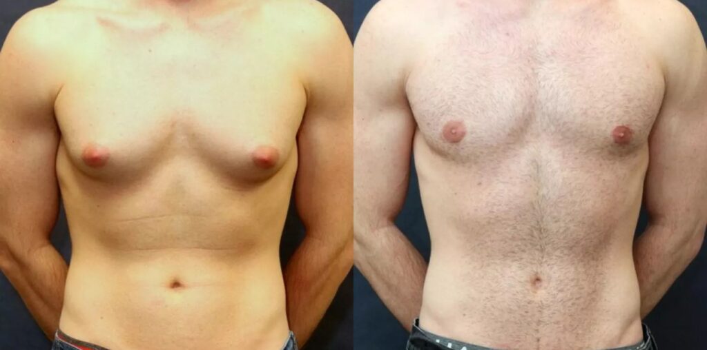 Gynecomastia in Dubai