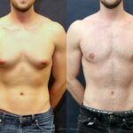 Gynecomastia in Dubai