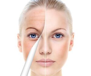 Rejuvenate Your Skin with Profractional Laser in Washington DC: Renu by Dr. Schoenfeld