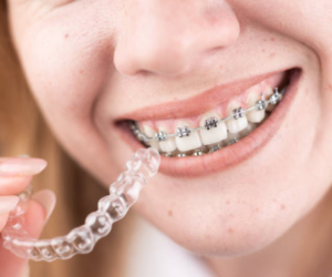 Do you wish to straighten your teeth without the use of metal braces? Try Clear Alignment in Mumbai!