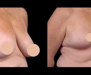 Exploring the Benefits of Breast Reduction in Dubai