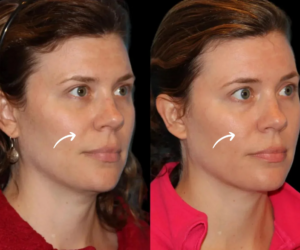 Why Sculptra Is Perfect for Non-Surgical Rejuvenation: Best Doctors in dubai Explain