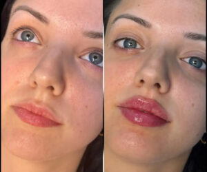 Best Plastic Surgeons in dubai: Fillers for Non-Surgical Jawline Sculpting