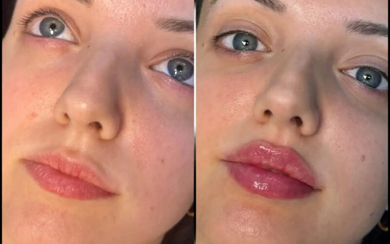 Best Plastic Surgeons in dubai: Fillers for Non-Surgical Jawline Sculpting