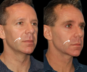 Sculptra for Chin Enhancement: Best Doctors in dubai Share Tips