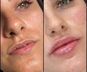 The Best Fillers in Dubai for a Natural Look