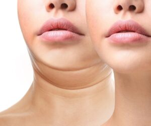 Is Double Chin Liposuction a Long-Term Solution?
