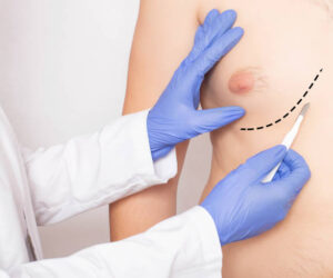 Does Gynecomastia Surgery Remove Scars?