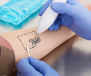 Discover the Benefits of Pico Tattoo Removal for Clear Skin