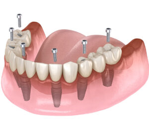 Recognizing the Need for Dental Implants in Your Oral Care