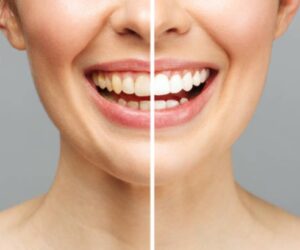 Acquire Your Ideal Grin with a Smile Designing in Mumbai!
