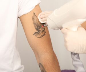 Why Laser Tattoo Removal in Dubai Helps You Say Goodbye to Unwanted Tattoos