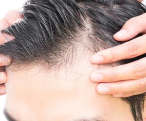 What Are the Long-Term Effects of Finasteride?