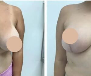 What to Expect During the Consultation for Breast Lift in Dubai