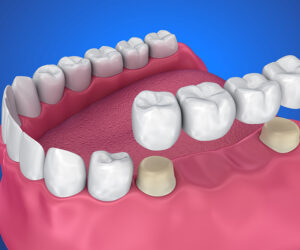 Strengthen Your Smile with Dental Bridges in Saskatoon