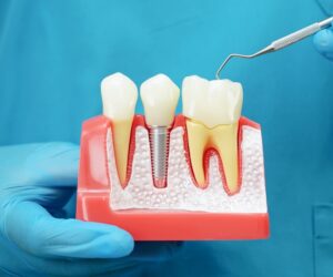 Are Dental Implants Right for You? Exploring the Benefits and Process