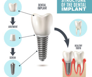 The Benefits of Dental Implants: Restoring Your Smile with Marigold Dental Clinic