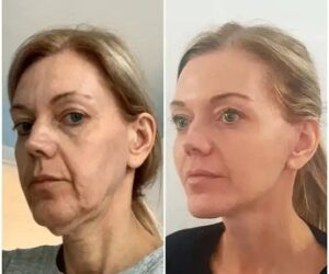 Profhilo Mastery by the Best Plastic Surgeons in dubai