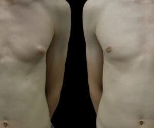 Gynecomastia in Dubai: Find the Top-Rated Surgeons