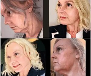 Profhilo Innovation at Best Aesthetic Clinics in dubai