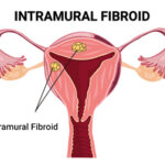 intramural fibroid