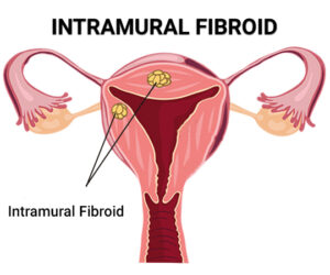 Understanding Intramural Fibroids: Causes, Symptoms, and Treatment
