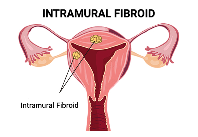 intramural fibroid