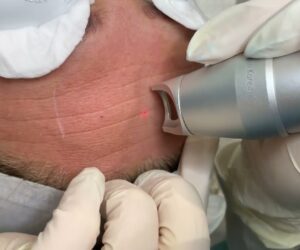 Pico Laser Treatment: The Miracle Solution for Uneven Skin Tone