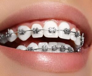 ClearCorrect in McKinney, TX: The Clear Path to a Straighter Smile