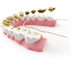 Tips to Avoid Discomfort While Wearing Lingual Braces
