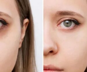 Enhance Your Beauty with Under Eye Fillers & Face Fillers in Delhi