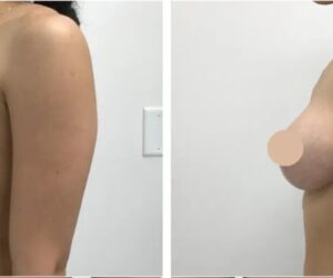 Why Women Trust the Best Breast Lift Doctors in Dubai